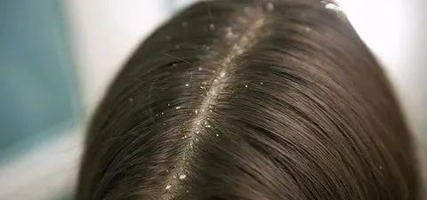 小手在頭皮抓呀抓呀抓，頭屑嘩啦啦！